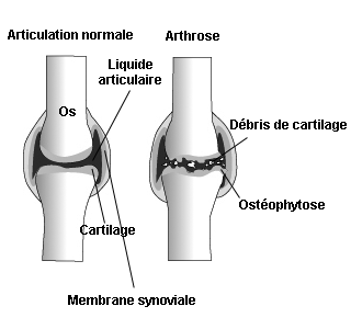 Arthrose : les articulations les plus touchées par l'arthrose - Arthrolink